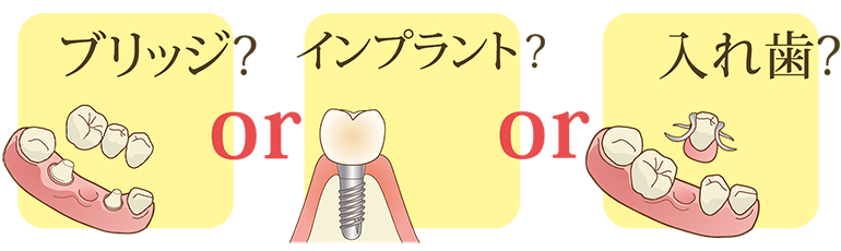 入れ歯という選択